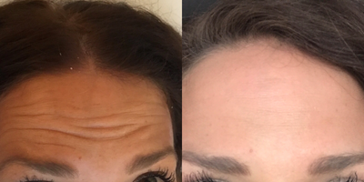 Botox before and after photo