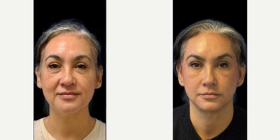 Deep Plane Facelift before and after photo