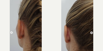 Ear Surgery before and after photo