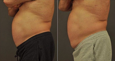 Emsculpt before and after photo