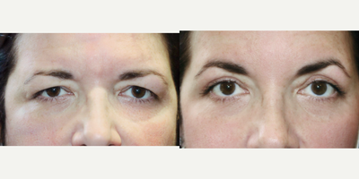 Eyelid Retraction Repair before and after photo