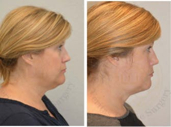 FaceTite before and after photo