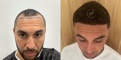 Hair Transplant before and after photo