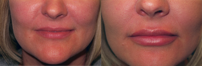 Lip Fillers before and after photo