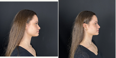Nonsurgical Nose Job before and after photo