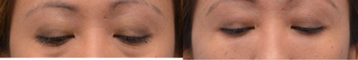 Restylane before and after photo
