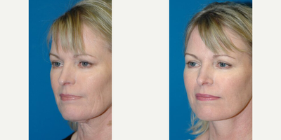 Facelift before and after photo