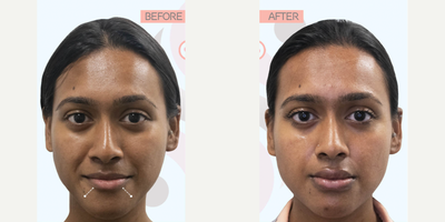 Lip Fillers before and after photo