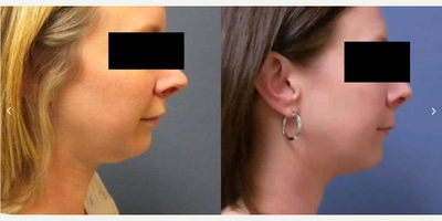Chin Liposuction before and after photo