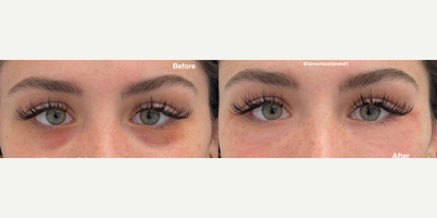 Coolaser before and after photo