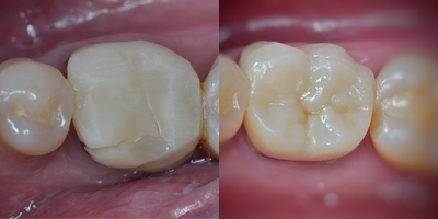 Dental Implants before and after photo