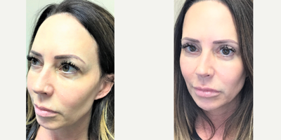 Eyelid Surgery before and after photo
