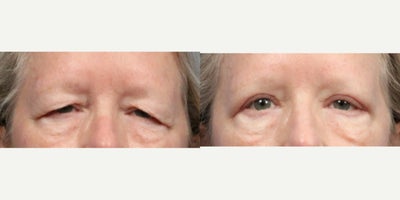 Eyelid Surgery before and after photo