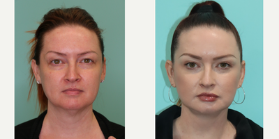 Facelift before and after photo