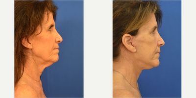 Facelift before and after photo