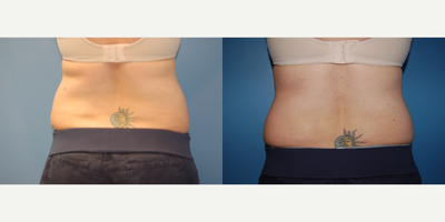 SculpSure before and after photo