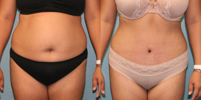 Tummy Tuck before and after photo