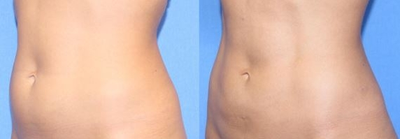 BodyTite before and after photo