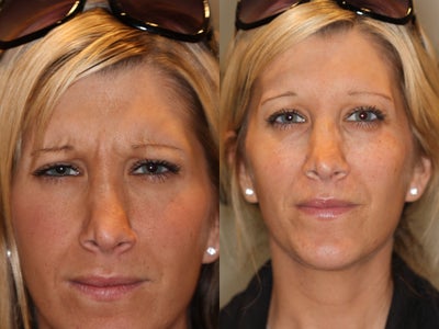 Botox before and after photo