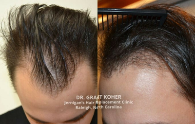 Hair Transplant before and after photo