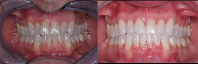 Invisalign before and after photo