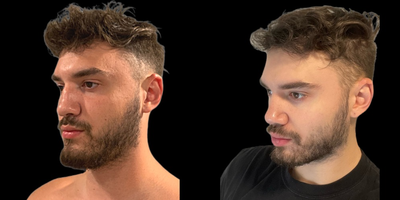 Rhinoplasty before and after photo