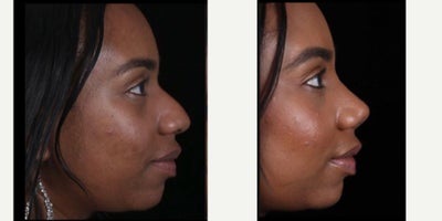 African American Rhinoplasty before and after photo