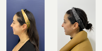 Botox before and after photo