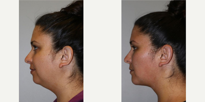 Buccal Fat Removal before and after photo