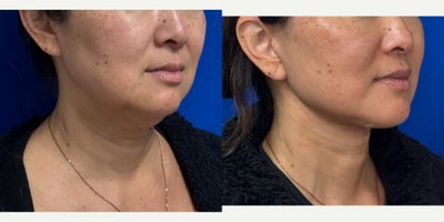 Deep Plane Facelift before and after photo