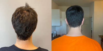 Hair Loss Treatment before and after photo