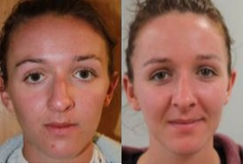 Rhinoplasty before and after photo