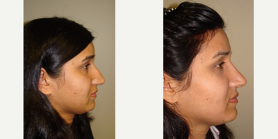Rhinoplasty before and after photo