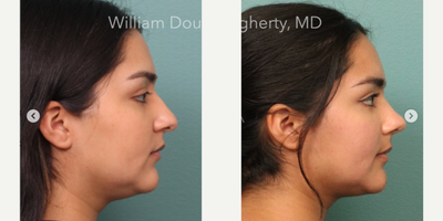 Rhinoplasty before and after photo