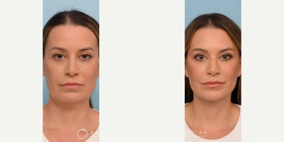 Eyelid Surgery before and after photo