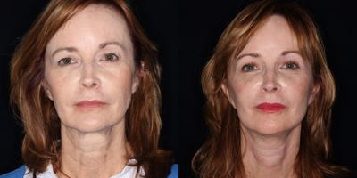 Facelift before and after photo