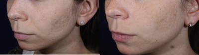 Fraxel Laser before and after photo