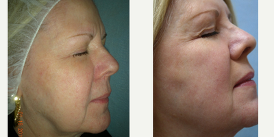IPL before and after photo