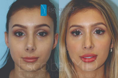 Revision Rhinoplasty before and after photo