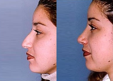 Rhinoplasty before and after photo