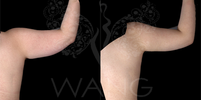 Smart Lipo before and after photo