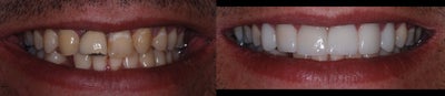 Dental Crown before and after photo