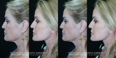 Facelift before and after photo