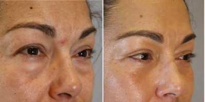 Facial Fat Transfer before and after photo