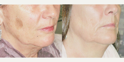 Fraxel Laser before and after photo