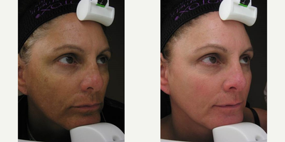 Laser Resurfacing before and after photo