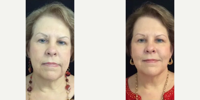 Voluma before and after photo