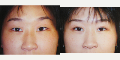 Eyelid Surgery before and after photo