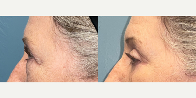 Eyelid Surgery before and after photo