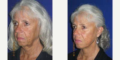 Facelift before and after photo